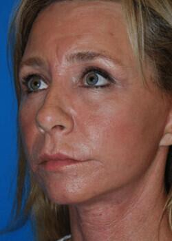 Facelift Before & After Image