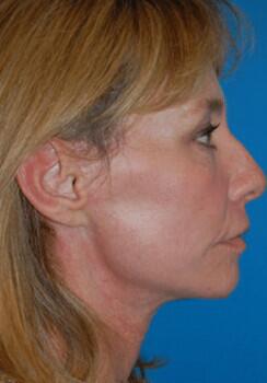 Facelift Before & After Image