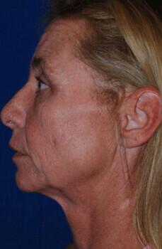 Facelift Before & After Image