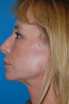 Facelift Before & After Image