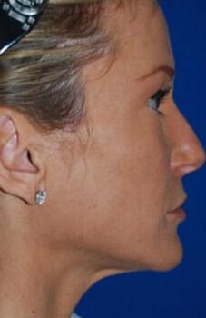 Facelift Before & After Image