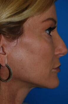 Facelift Before & After Image