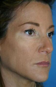 Facelift Before & After Image