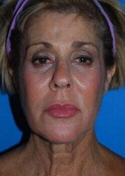 Facelift Before & After Image