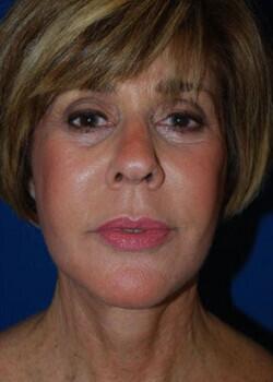 Facelift Before & After Image