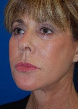 Facelift Before & After Image