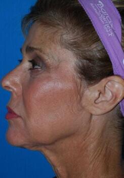 Facelift Before & After Image