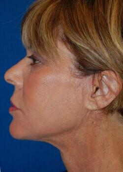 Facelift Before & After Image