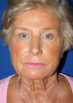 Facelift Before & After Image