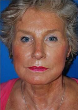 Facelift Before & After Image