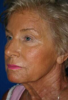 Facelift Before & After Image