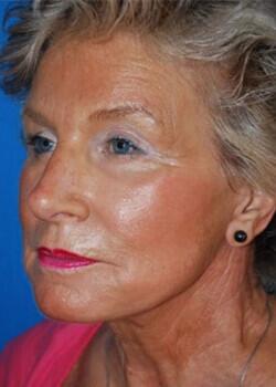 Facelift Before & After Image