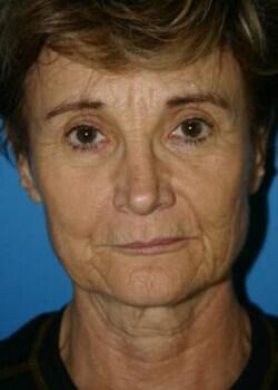 Facelift Before & After Image