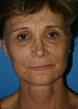 Facelift Before & After Image