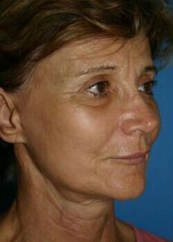 Facelift Before & After Image