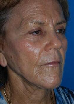 Facelift Before & After Image