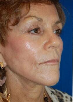 Facelift Before & After Image