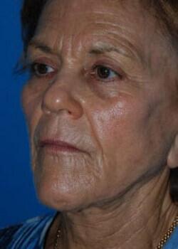 Facelift Before & After Image