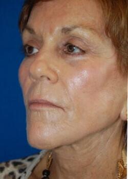 Facelift Before & After Image