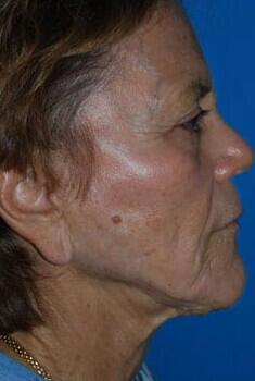 Facelift Before & After Image