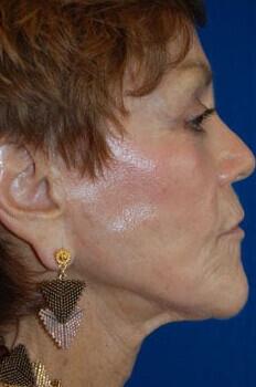 Facelift Before & After Image