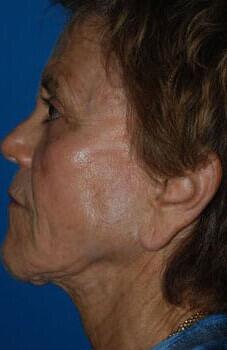 Facelift Before & After Image