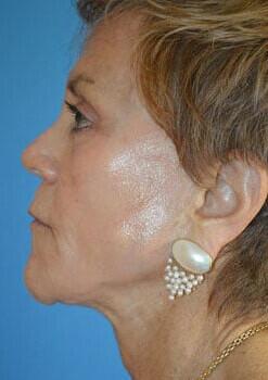 Facelift Before & After Image