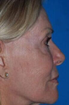 Facelift Before & After Image