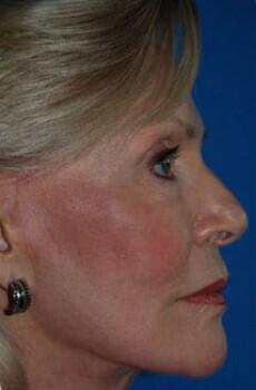 Facelift Before & After Image