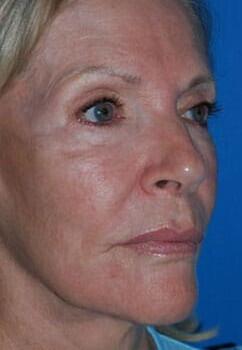 Facelift Before & After Image