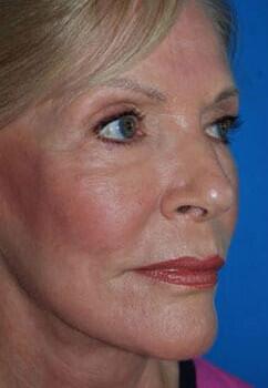 Facelift Before & After Image