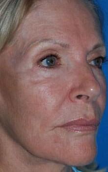 Facelift Before & After Image