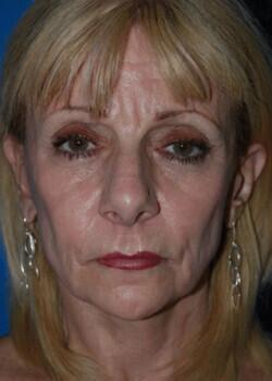 Facelift Before & After Image