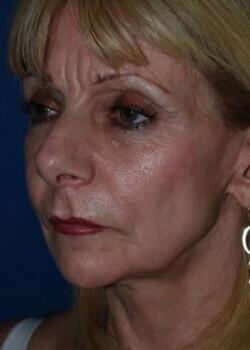 Facelift Before & After Image