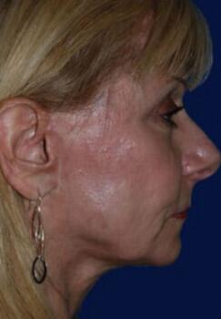 Facelift Before & After Image