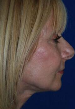 Facelift Before & After Image
