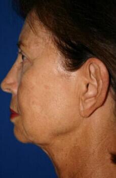 Facelift Before & After Image