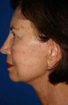 Facelift Before & After Image