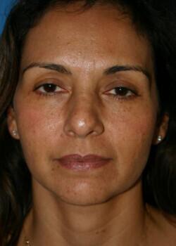 Facelift Before & After Image