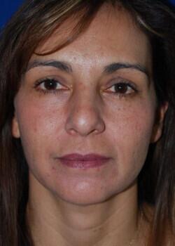 Facelift Before & After Image