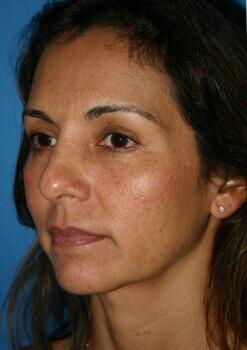 Facelift Before & After Image