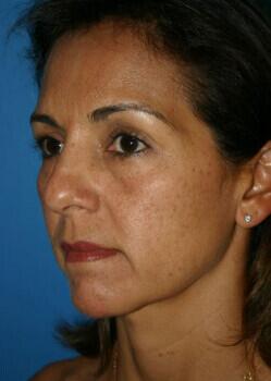 Facelift Before & After Image