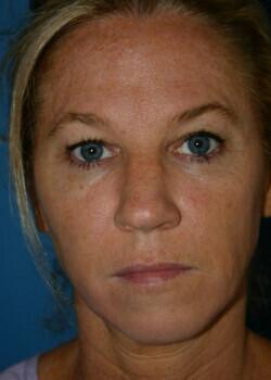 Facelift Before & After Image