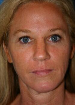 Facelift Before & After Image