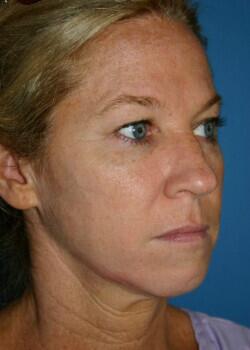 Facelift Before & After Image