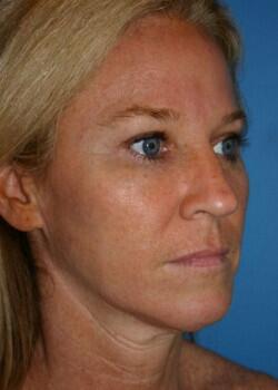 Facelift Before & After Image