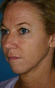 Facelift Before & After Image