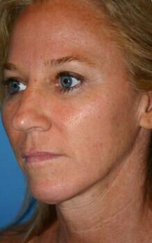 Facelift Before & After Image