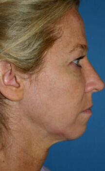Facelift Before & After Image