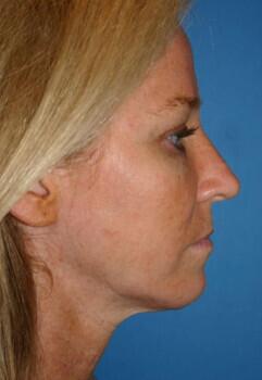 Facelift Before & After Image